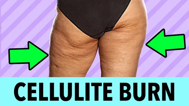 how to get rid of dents in buttocks